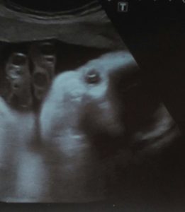 groeiecho echo echografie