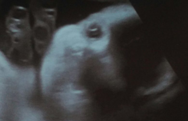 groeiecho echo echografie